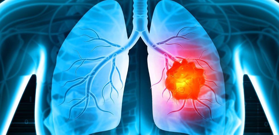 Understanding Lung Cancer: Symptoms and Diagnosis Lung Cancer
